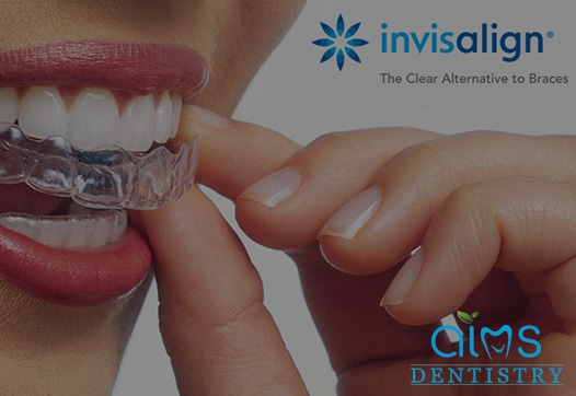 Invisalign clear aligner