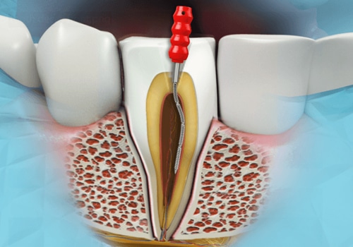 Rendering of root canal procedure